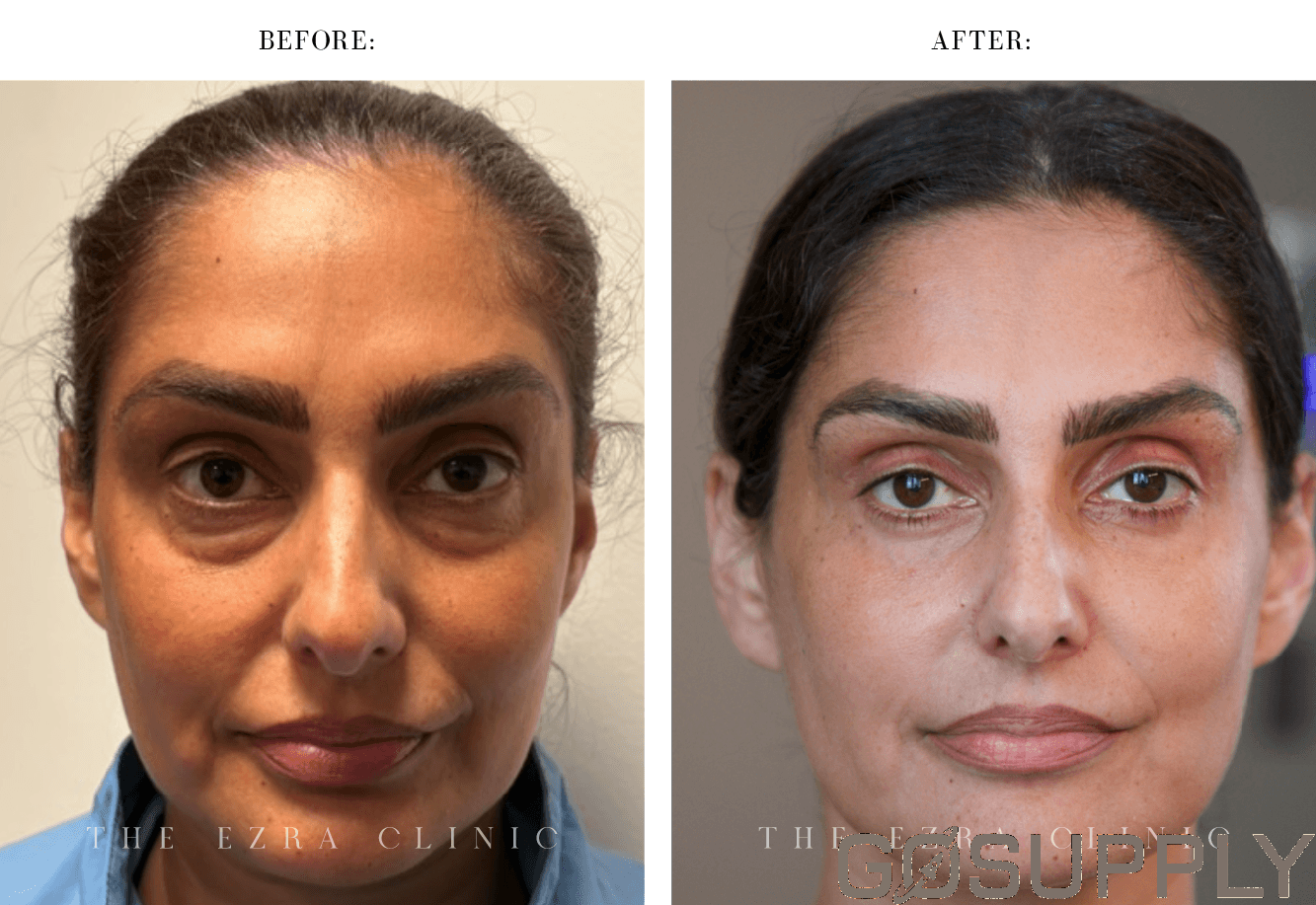 Bilateral Blepharoplasty Drape, No Pouch