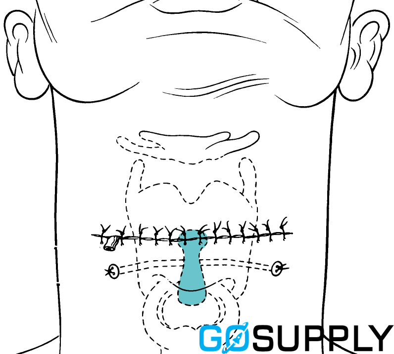 MONTGOMERY® LARYNGEAL STENT - Thumbnail 4